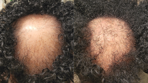 Before and after result