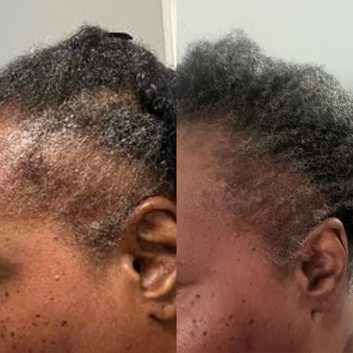 Before and after showing fuller edges and temples